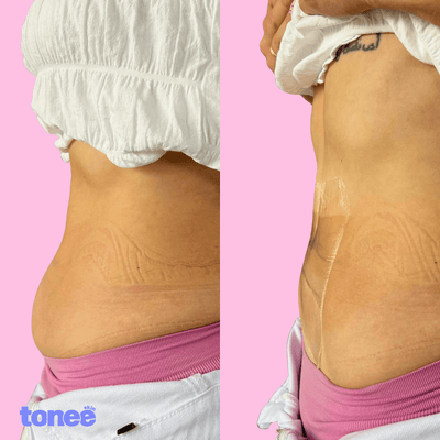 TonSkinn | PATCHS LIFT & SCULPT